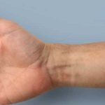 Sistema de alarma para alertar sobre un cáncer