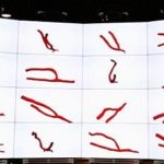 Avances en 3D para el tratamiento de diálisis