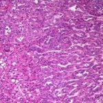 Con algoritmo..  detectan inicio del cáncer de hígado