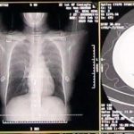 Con apoyo de algoritmo, diagnostican coronavirus .. en 20 segundos