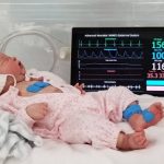 Monitores para bebés prematuros .. de países pobres