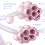 COVID-19: Ilustración sobre el proceso de infección del pulmón