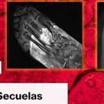 Covid-19:.. secuelas: dedos covid, artritis , gangrena..