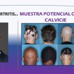 Droga para la artritis.. muestra efectividad contra la alopecia